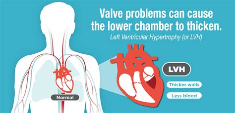 what causes lvh in women